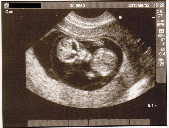 ultrasound image of alien fetus
